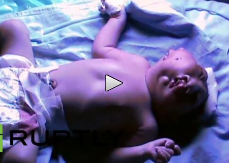 Copil cu două feţe, născut în India. Doctorii sunt ULUIŢI (VIDEO)