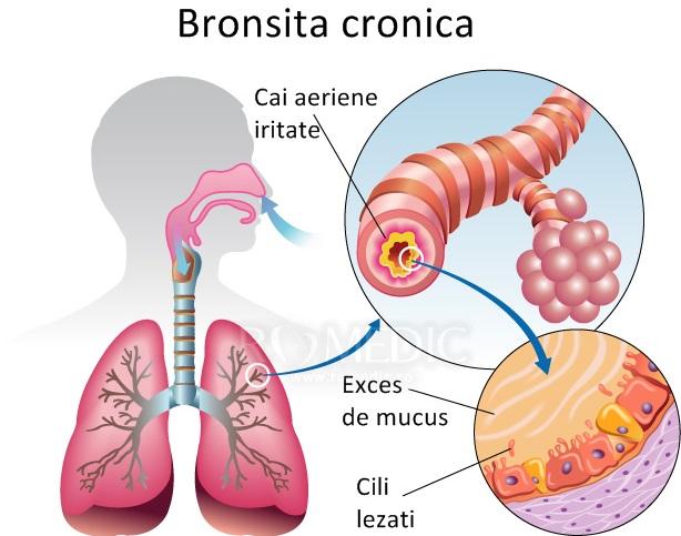 Bronşita cronică