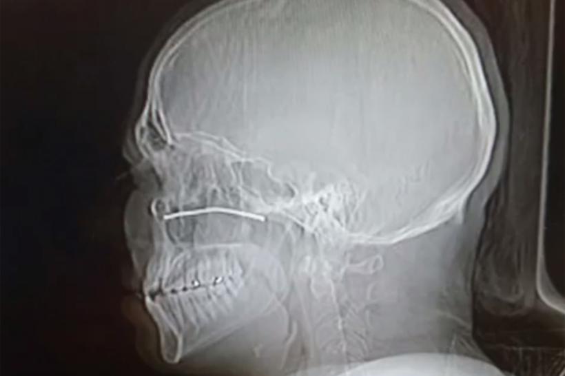 Un bărbat a supraviețuit după ce o bucată de metal i s-a înfipt în cap (VIDEO)