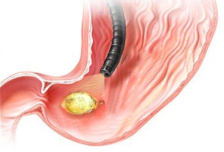 Remedii naturiste în ulcerul gastric și duodenal
