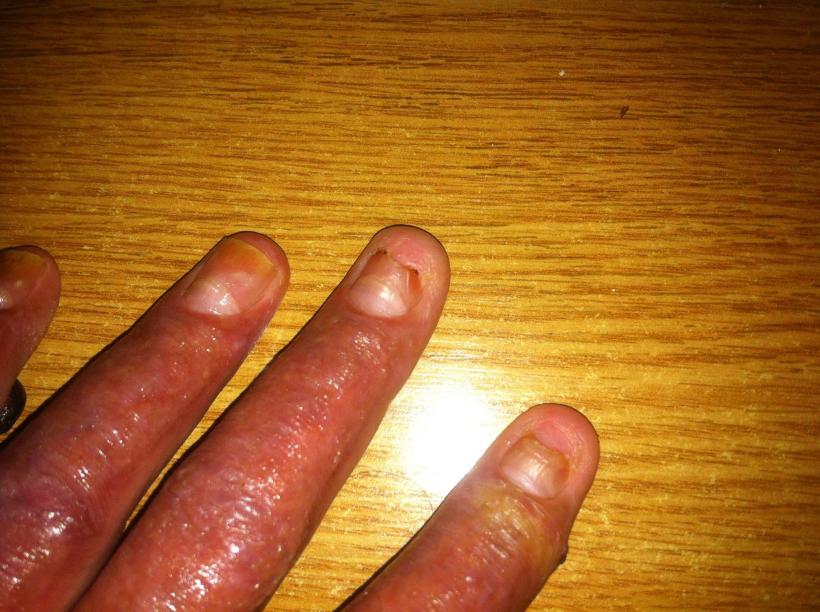 Imagini șocante postate de un rănit în tragedia din Colectiv 18524775