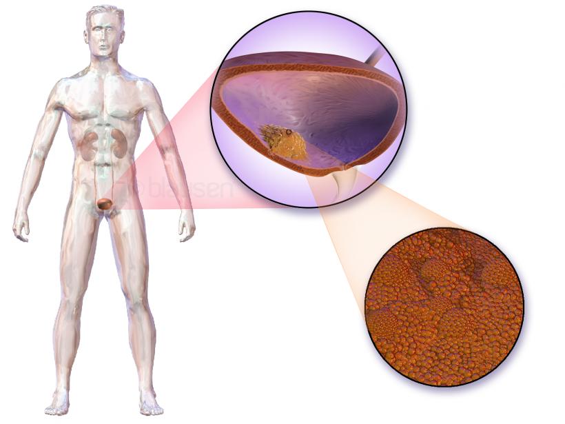 Cancerul de vezică urinară, o afecţiune gravă care poate trece neobservată