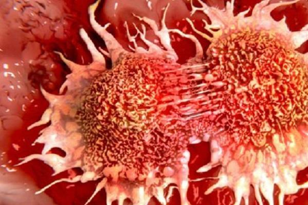 10 factori care cauzează cancer. Folosim zilnic aceste produse