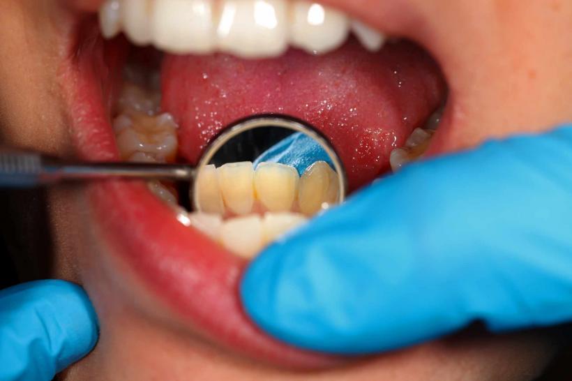 Sfatul medicului: Cum recunoşti şi tratezi un abces dentar?