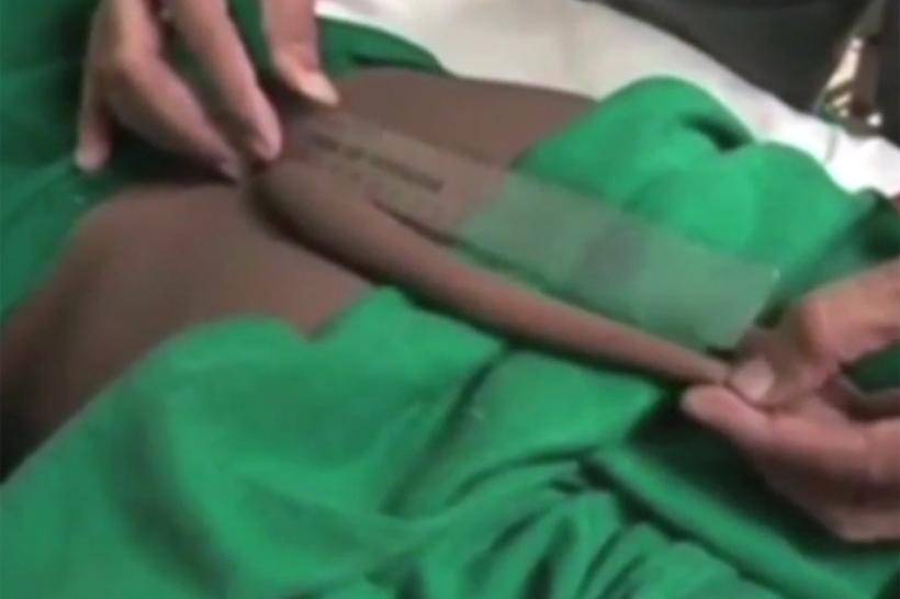 VIDEO - Neurochirurgii indieni au trebuit să extirpe cea mai lungă coadă a unui om