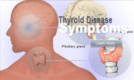 Semne că nu slăbești sau nu te îngrași din cauza tiroidei