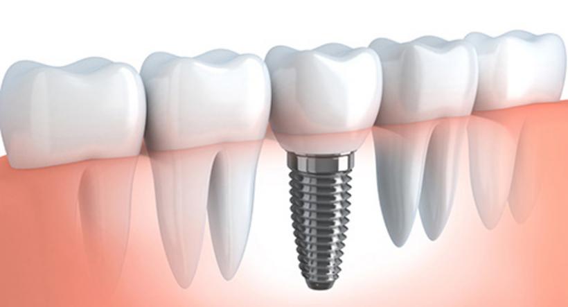 (P) Ofera-ti un zambet nou de Sarbatori – implanturi dentare rapide la Dr. Leahu