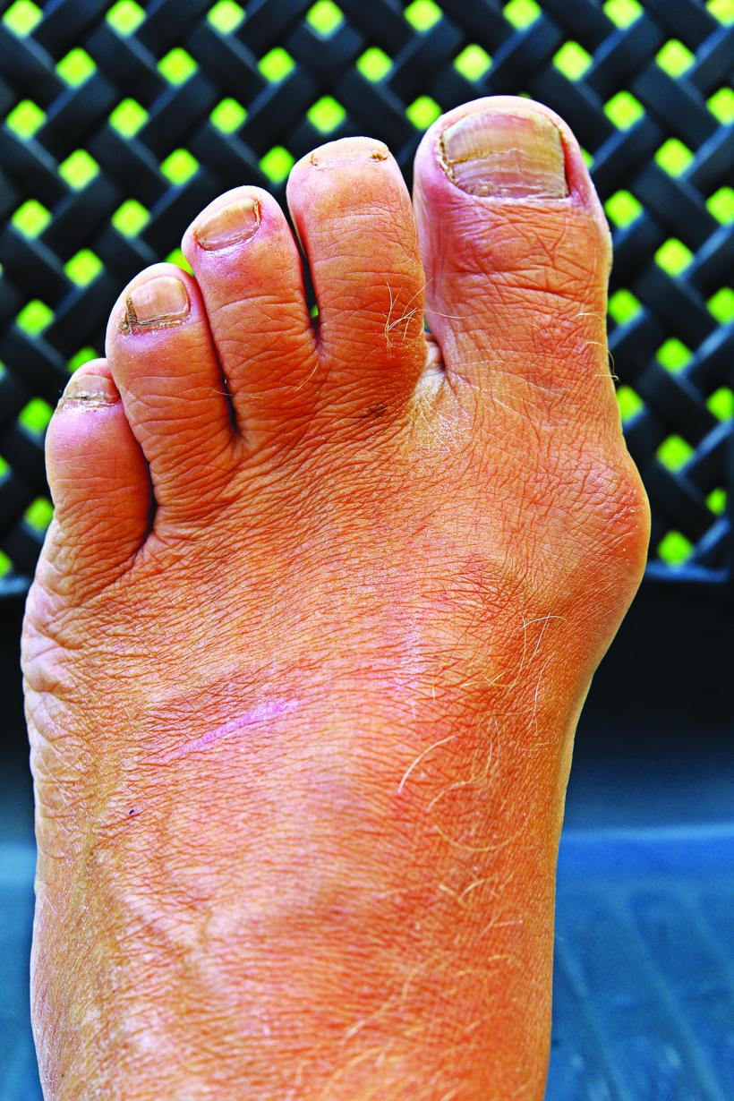 Semnal de alarmă: deformările și durerile de la degetele mari ale picioarelor