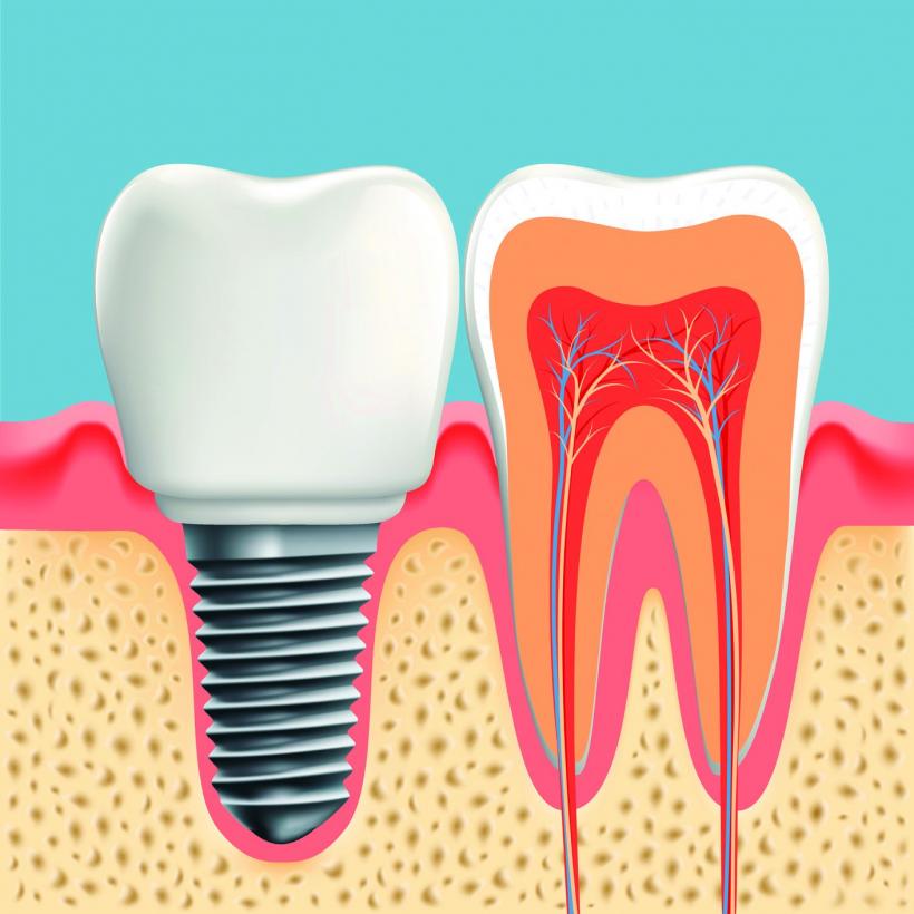 Implantul dentar implică multe vizite la medic şi o igienă bucală ireproşabilă