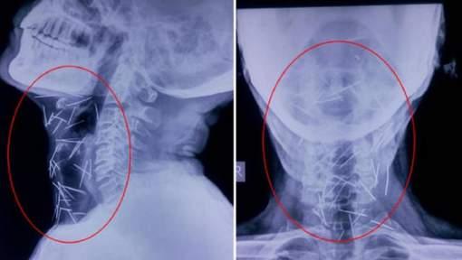 Medicii au fost șocați să descopere 75 de ace infipte în corpul unui pacient care avea dureri într-un picior