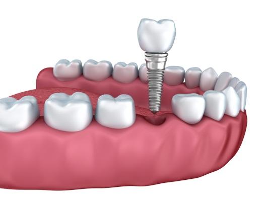 (P) Cele mai frecvente riscuri postoperatorii ale implantului dentar