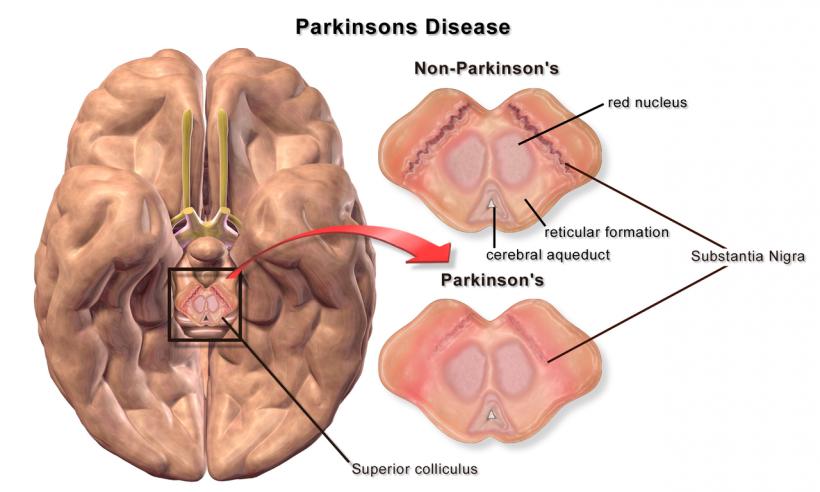 Medicament pentru diabet benefic în tratarea bolii Parkinson