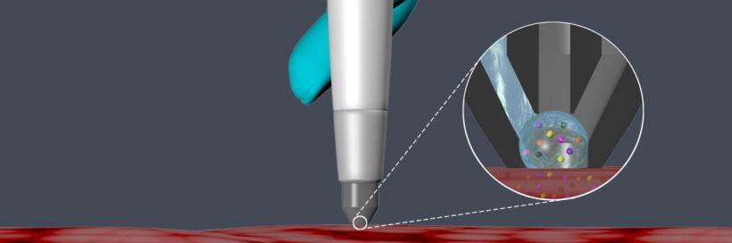O sondă de mărimea unui stilou detectează celulele canceroase în 10 secunde