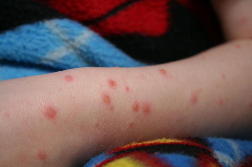 Un băiat de trei ani a murit după ce şi-a rupt o erupţie cutanată cauzată de varicelă