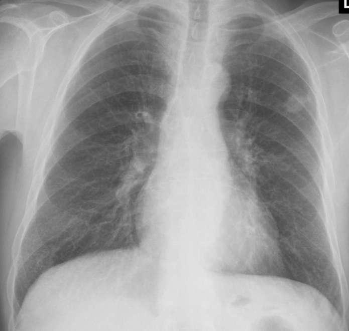 În fiecare oră, un român este diagnosticat cu o formă de cancer pulmonar. Ce trebuie să știi despre diagnosticul precoce și tratament