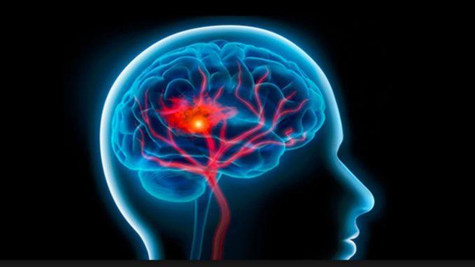 La fiecare cinci secunde un om moare de Accident Vascular Cerebral. Ce spun medicii români?