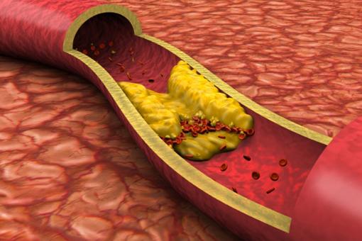 Arteriopatia periferică - ce este și cum se tratează
