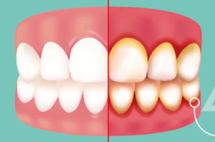 Gingivita – cea mai neglijată problemă dentară cu consecinţe grave - cum o prevenim, cum o tratăm?