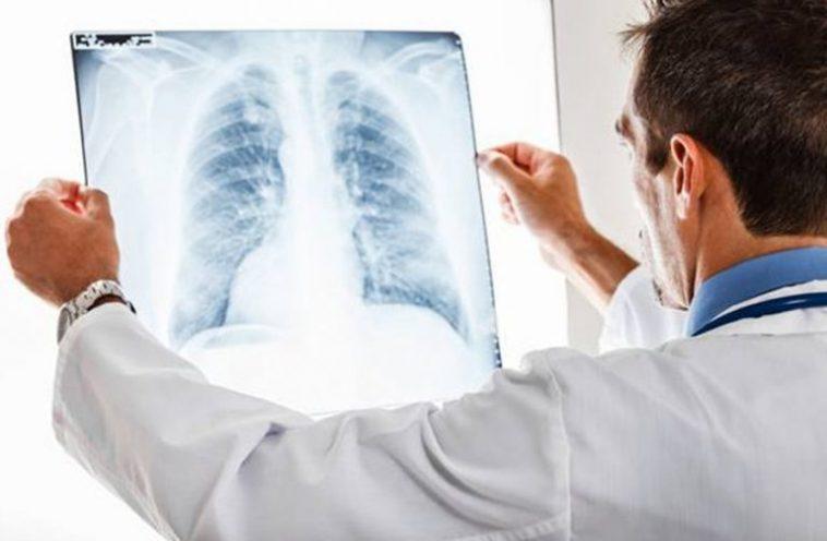 Alarmant! Peste 10.000 de cazuri noi de cancer pulmonar depistate anual în România