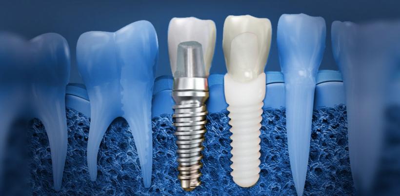 Implantul dentar - ce trebuie să știi despre el: recomandări și riscuri