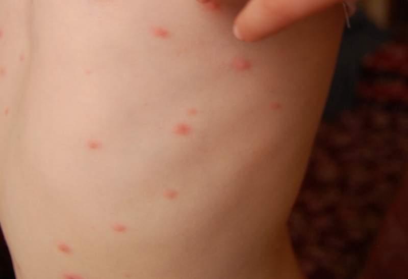Focare de varicelă la o școală din Slatina și la o grădiniță din Balș
