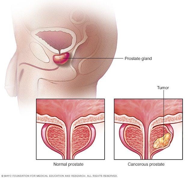 Cancerul de prostată – diagnostic și tratament