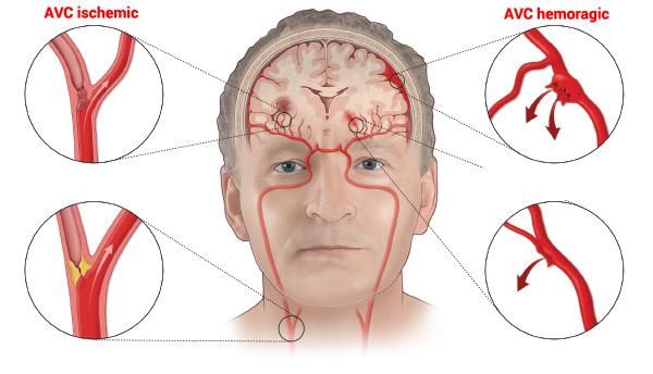 Accident vascular cerebral (AVC) – Simptome, tratament și recuperare