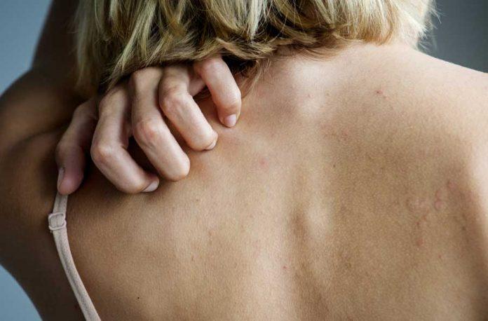 Eczema – simptome, cauze și tipuri de tratament