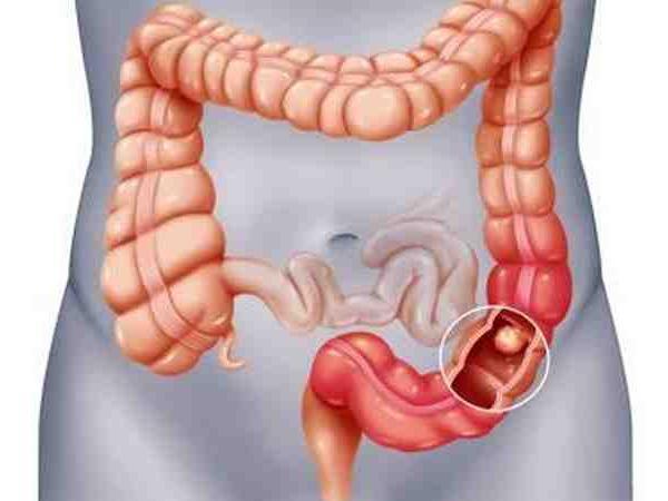 Rezecțiile colo-rectale laparoscopice, în cancerul de colon sau rect