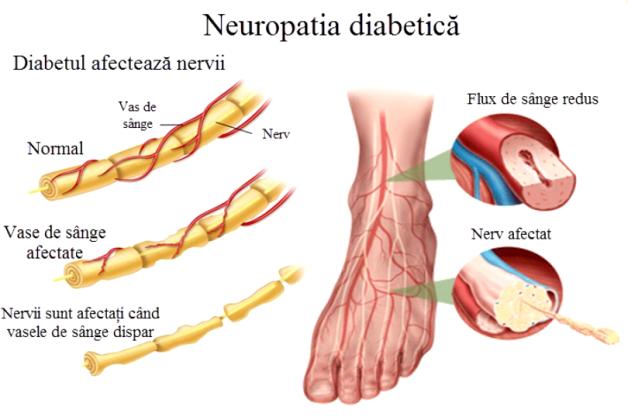 Neuropatia diabetică - Diabetul zaharat, pericol major pentru sănătatea picioarelor
