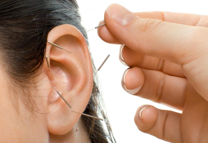 Acupunctura în lobul urechii