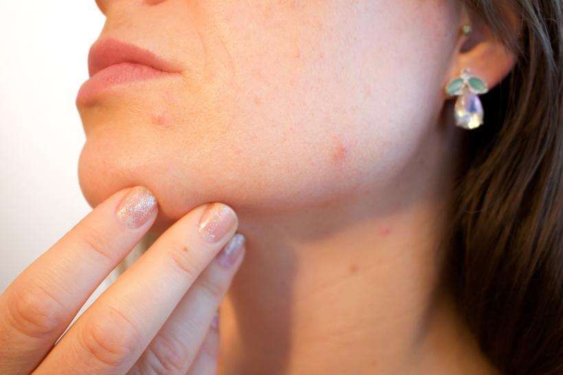 Cum tratăm acneea care apare la maturitate