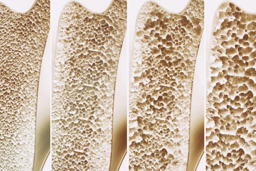 Anotimpul rece, factor de risc pentru osteoporoză