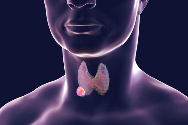 Cancerul tiroidian - semne, diagnostic, tratament