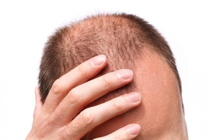 Căderea părului: cauze neașteptate