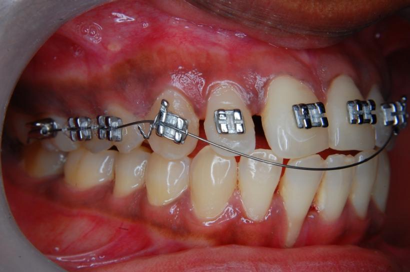 Ortodonție: cum să vă curățați dinții atunci când aveți un aparat dentar?
