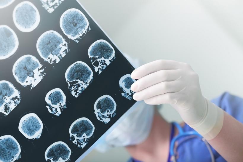 Cancerul cerebral – simptome, diagnostic, tratament
