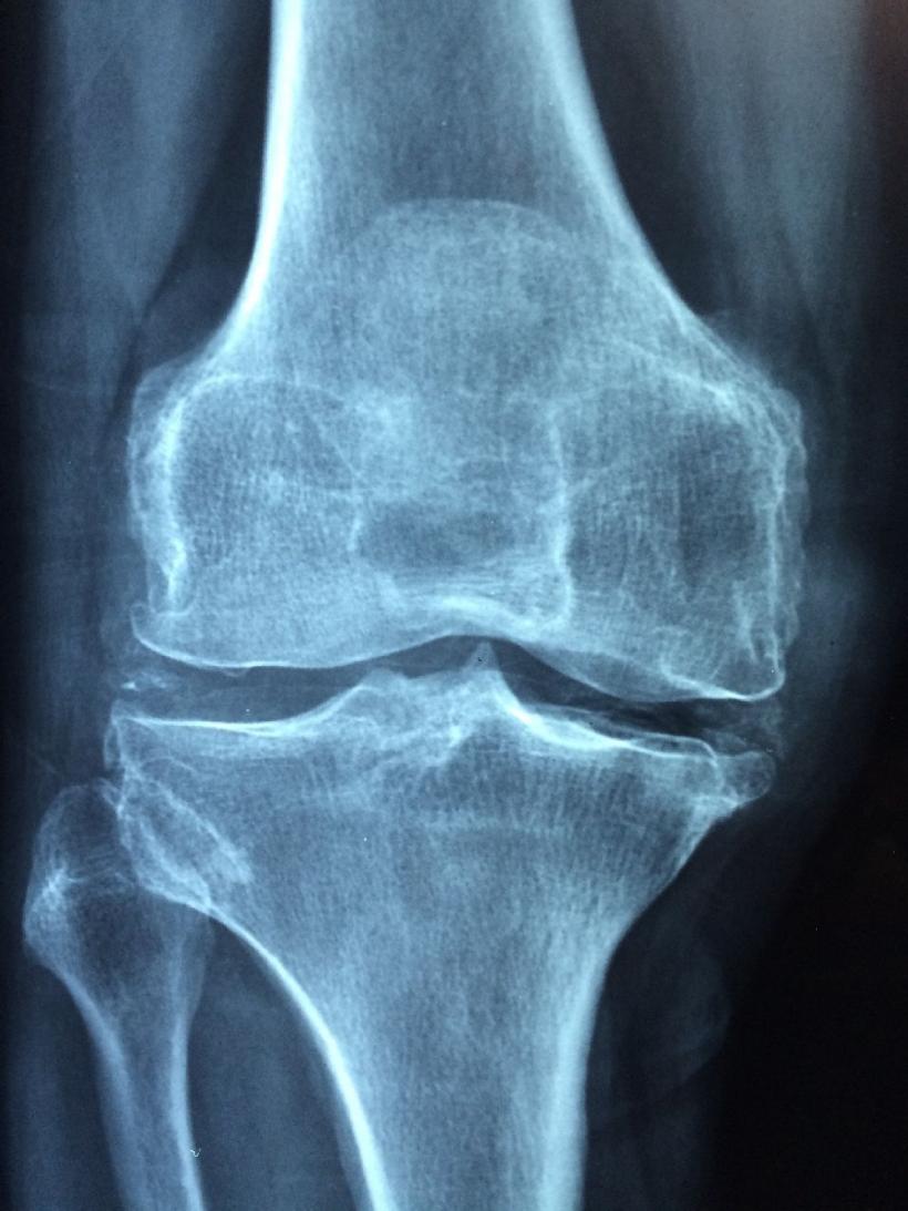 Osteoporoza e o pierdere de substanţă osoasă cu fragilizarea oaselor