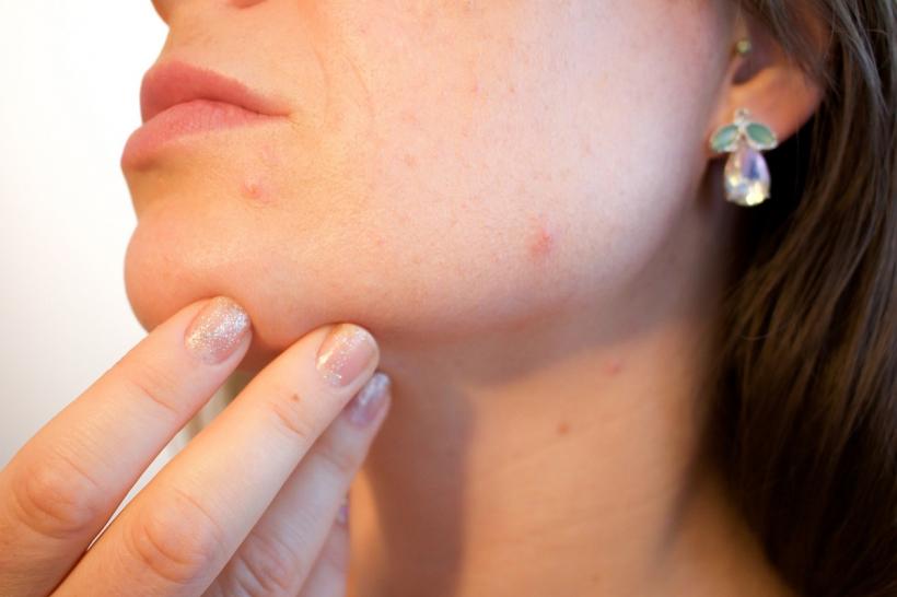 Cinci mituri despre acnee