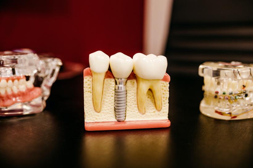 6 lucruri pe care nu le știai despre implanturile dentare