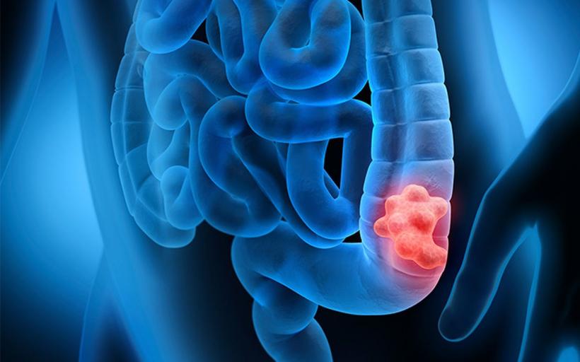 Cancerul de colon poate fi confundat cu sindromul intestinului iritabil