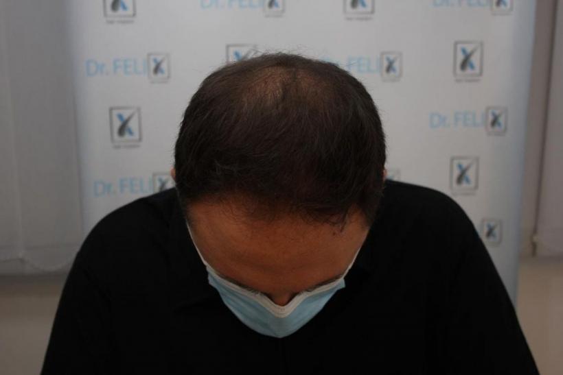 Chelie timpurie? Transplantul de păr în clinica Dr. Felix Hair Implant poate fi soluție 