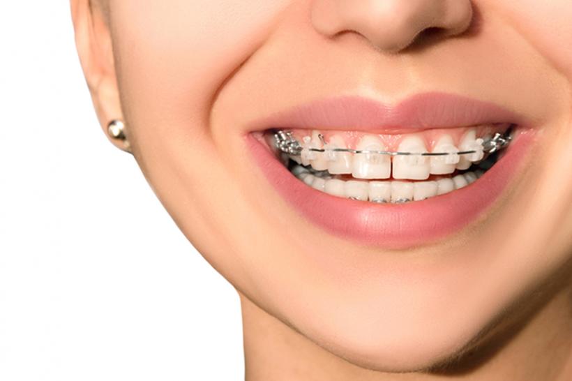 5 motive pentru care ar trebui să îți pui aparat dentar