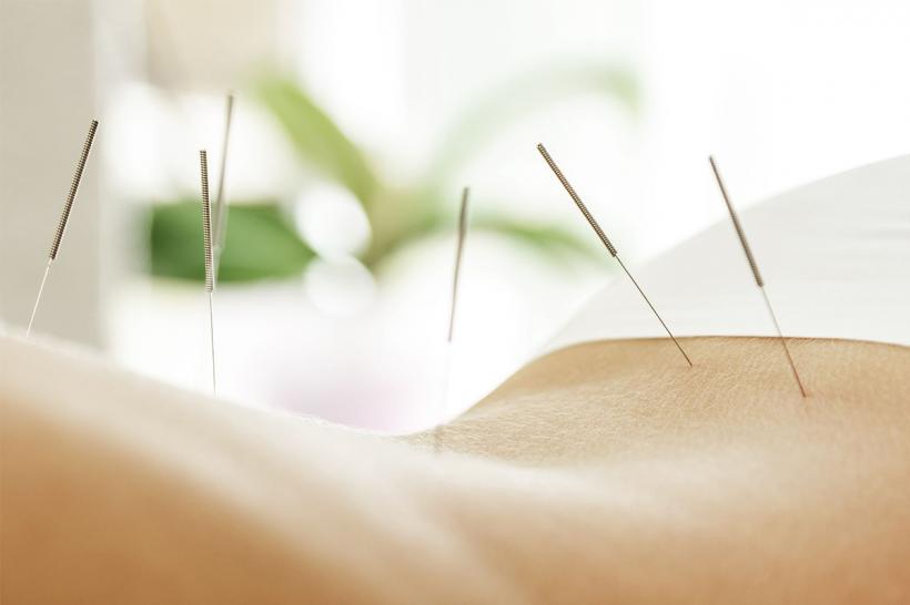 Cum putem opri durerea prin acupunctură