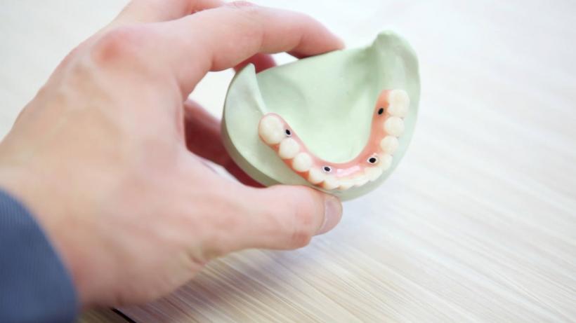 Implantul dentar și etapele acestei proceduri