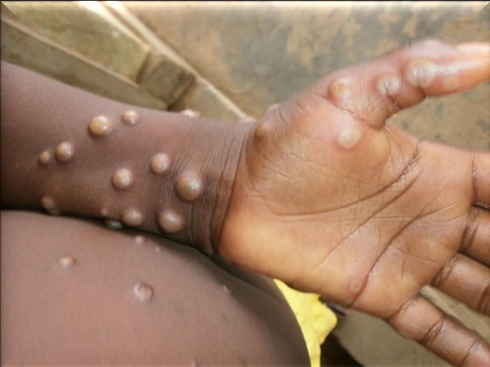 Numărul cazurilor de variola maimuţei din Spania a crescut la 21
