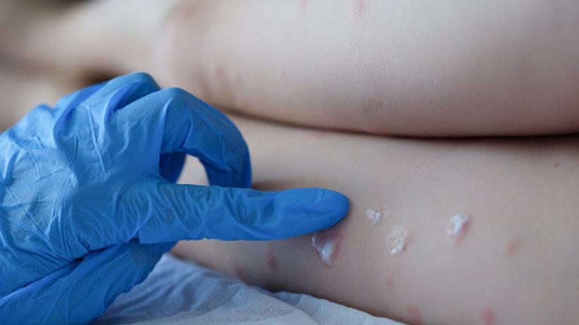 Al șaselea caz de variola maimuței confirmat în România