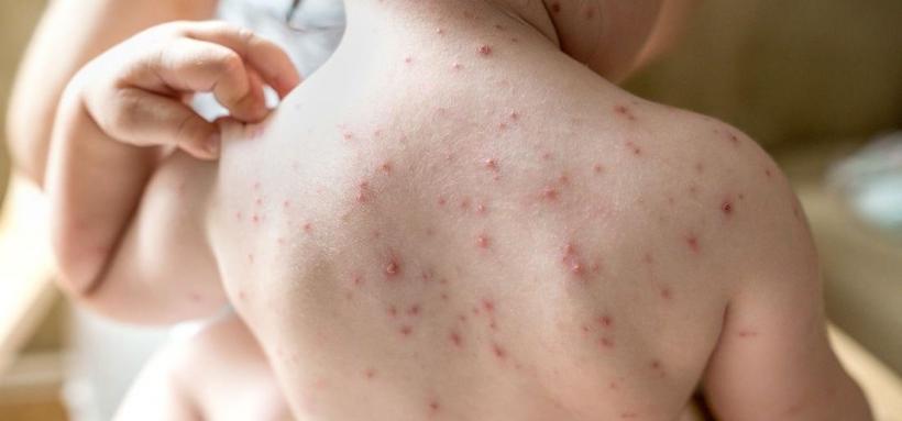 OMS: 72 de copii, printre cele peste 17.000 de cazuri de variola maimuței