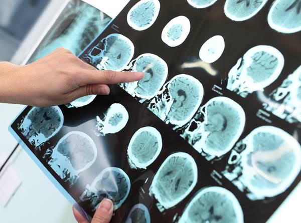 Un nou sistem de tratament pentru cancerul cerebral