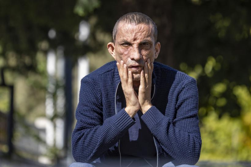 Prima persoană care a făcut un transplant de față în Turcia, Ugur Acar, surprins într-o ședință foto 18807815